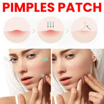 Ultimate Repair Acne Patch - 200 Patches for Clearer Skin