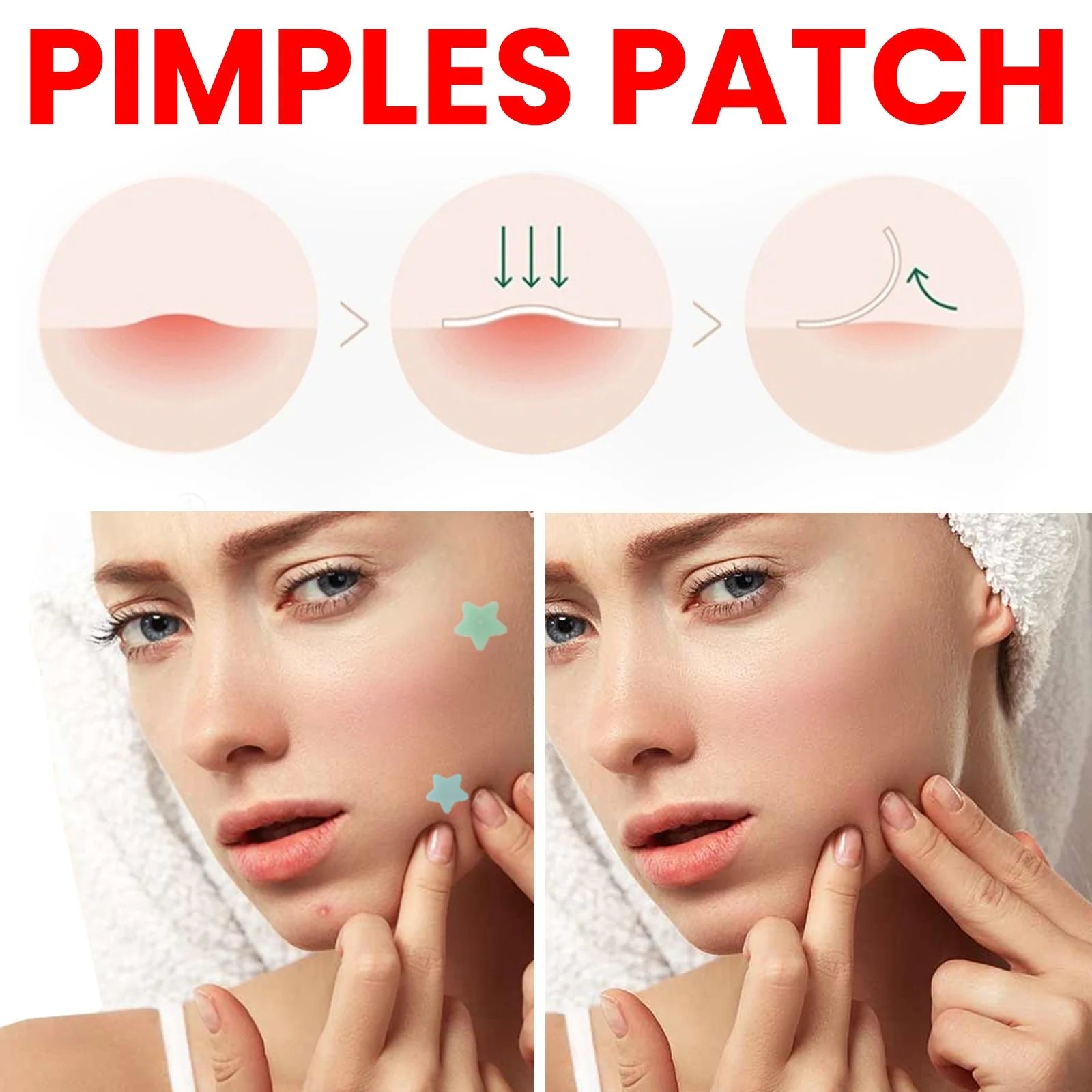 Ultimate Repair Acne Patch - 200 Patches for Clearer Skin