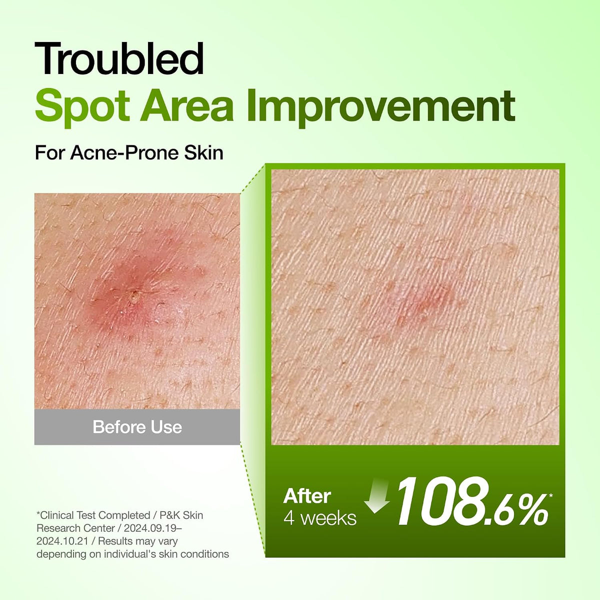 Revitalize Your Complexion with Our Azelaic Acid 10% & Hyaluronic Acid Redness Relief Serum - Lightweight Hydration for Blemish-Prone & Oily Skin, 1.01 Fl Oz