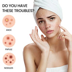 Ultimate Repair Acne Patch - 200 Patches for Clearer Skin